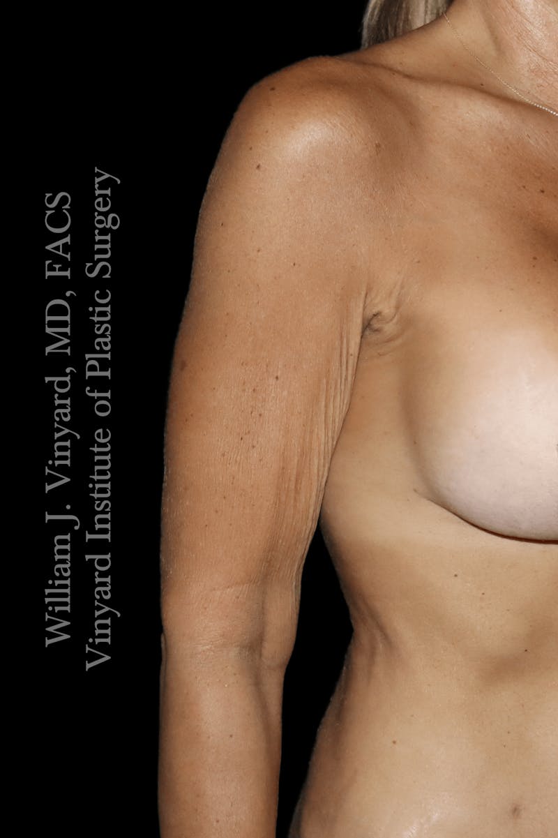 Arm Lift Before & After Gallery - Patient 320972 - Image 5