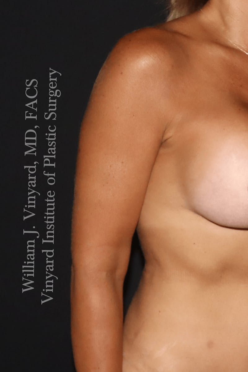 Arm Lift Before & After Gallery - Patient 320972 - Image 6