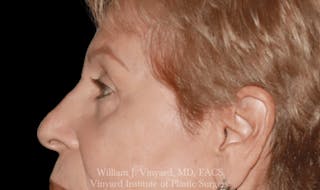 Eyelid Before & After Gallery - Patient 370699 - Image 8