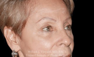 Eyelid Before & After Gallery - Patient 370699 - Image 4