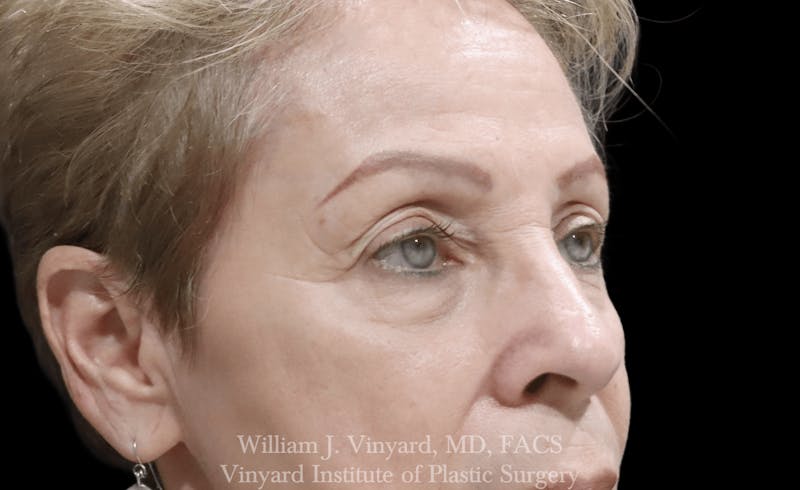 Eyelid Before & After Gallery - Patient 370699 - Image 3