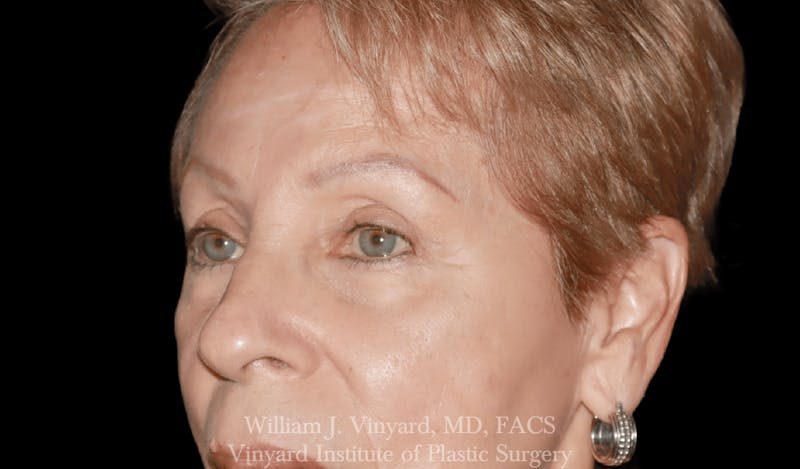 Eyelid Before & After Gallery - Patient 370699 - Image 6