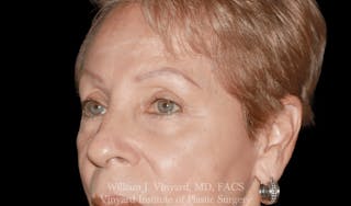 Eyelid Before & After Gallery - Patient 370699 - Image 6