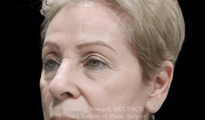 Eyelid Before & After Gallery - Patient 370699 - Image 5