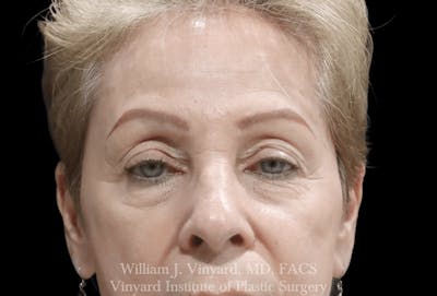 Eyelid Before & After Gallery - Patient 370699 - Image 1