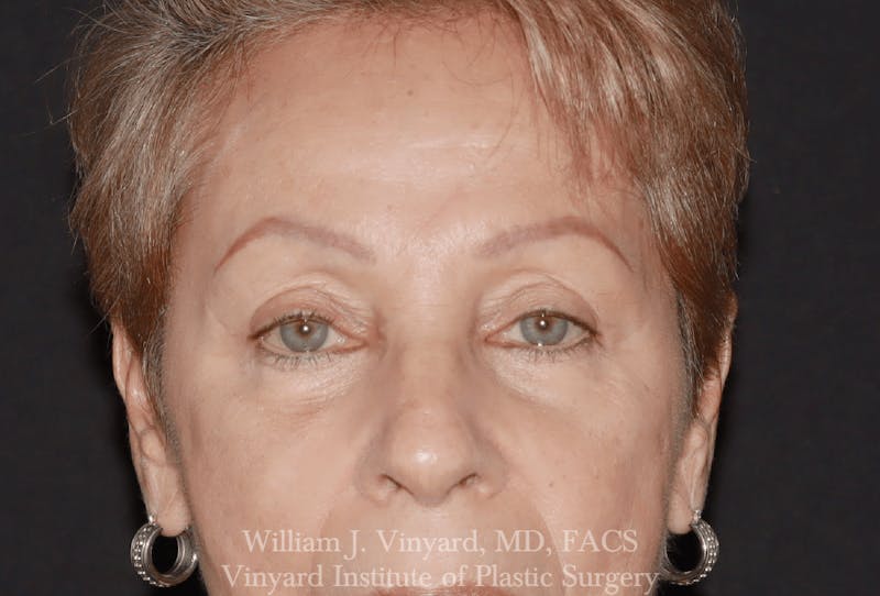 Eyelid Before & After Gallery - Patient 370699 - Image 2