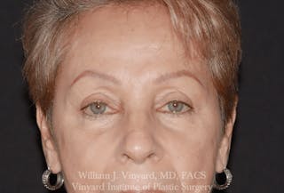 Eyelid Before & After Gallery - Patient 370699 - Image 2