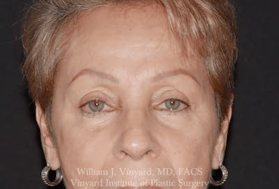Eyelid Before & After Gallery - Patient 370699 - Image 2