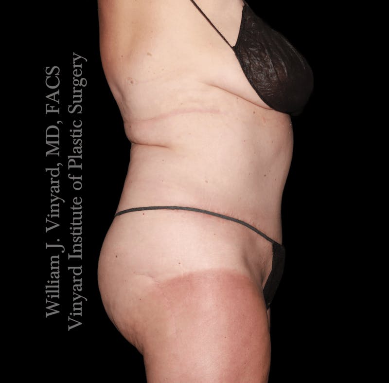 Tummy Tuck Before & After Gallery - Patient 423494 - Image 4