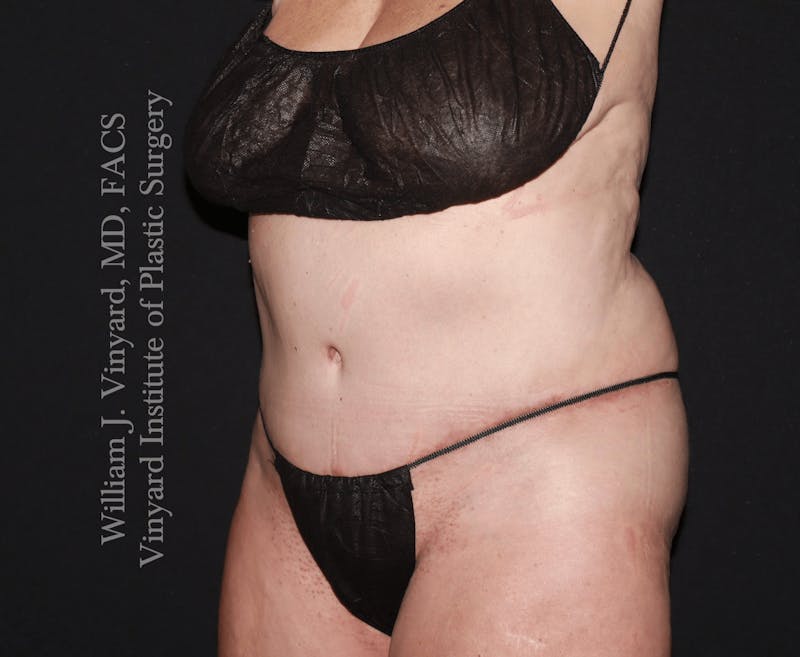 Tummy Tuck Before & After Gallery - Patient 423494 - Image 6