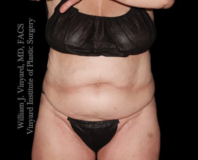 Tummy Tuck Before & After Gallery - Patient 423494 - Image 1