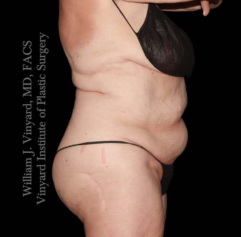 Tummy Tuck Before & After Gallery - Patient 423494 - Image 3