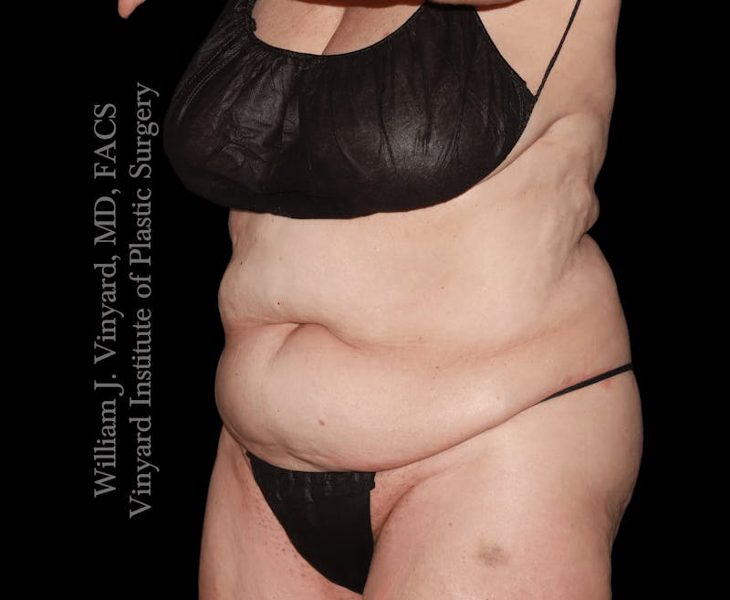 Tummy Tuck Before & After Gallery - Patient 423494 - Image 5