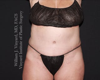 Tummy Tuck Before & After Gallery - Patient 423494 - Image 2