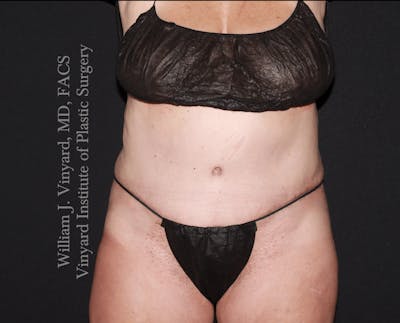 Tummy Tuck Before & After Gallery - Patient 423494 - Image 2