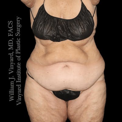 Tummy Tuck Before & After Gallery - Patient 114794 - Image 1