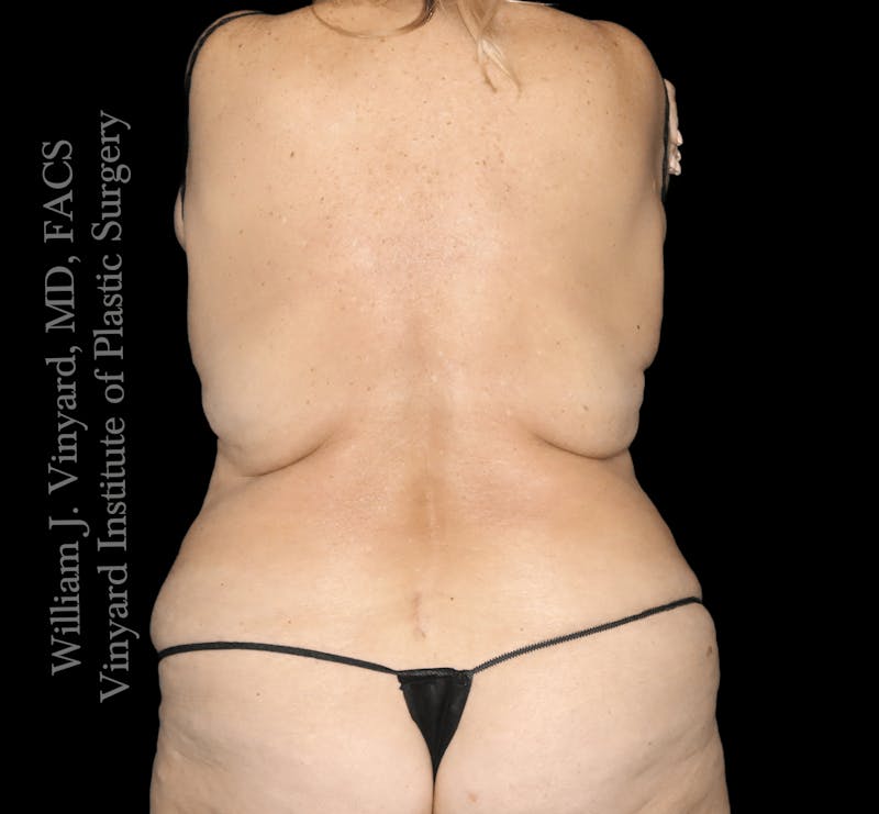 Tummy Tuck Before & After Gallery - Patient 114794 - Image 7