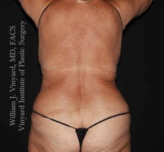 Tummy Tuck Before & After Gallery - Patient 114794 - Image 8