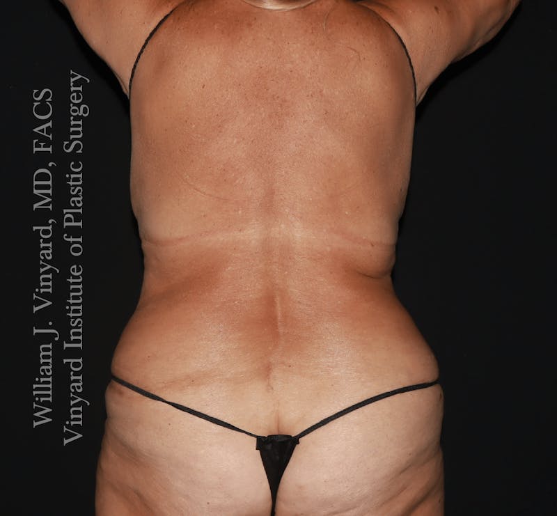 Tummy Tuck Before & After Gallery - Patient 114794 - Image 8