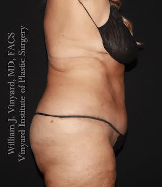 Tummy Tuck Before & After Gallery - Patient 114794 - Image 4