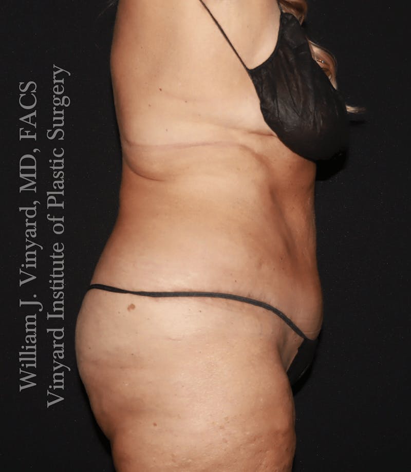 Tummy Tuck Before & After Gallery - Patient 114794 - Image 4