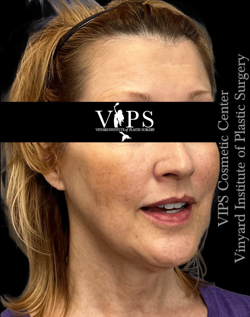 ELLUMINATE WITH IPL Before & After Gallery - Patient 361340 - Image 1