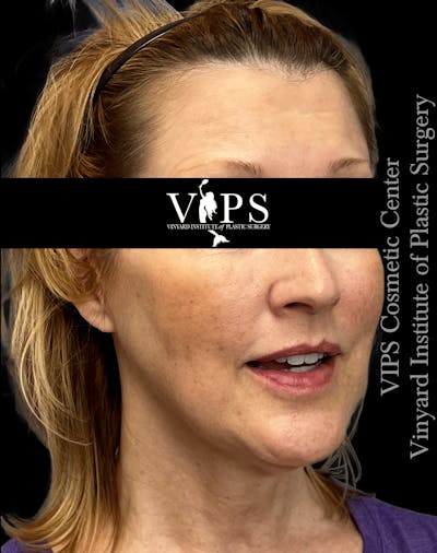 ELLUMINATE WITH IPL Before & After Gallery - Patient 361340 - Image 1
