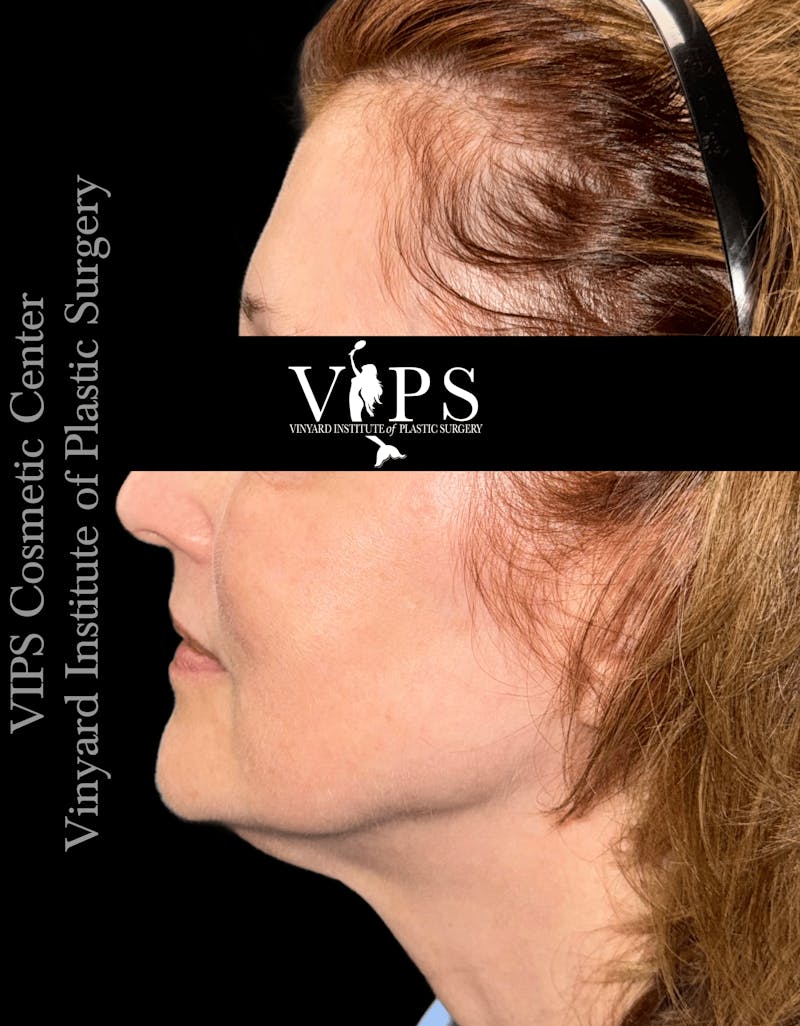 ELLUMINATE WITH IPL Before & After Gallery - Patient 361340 - Image 4
