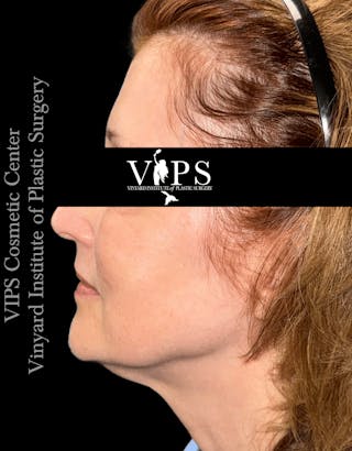 ELLUMINATE WITH IPL Before & After Gallery - Patient 361340 - Image 4