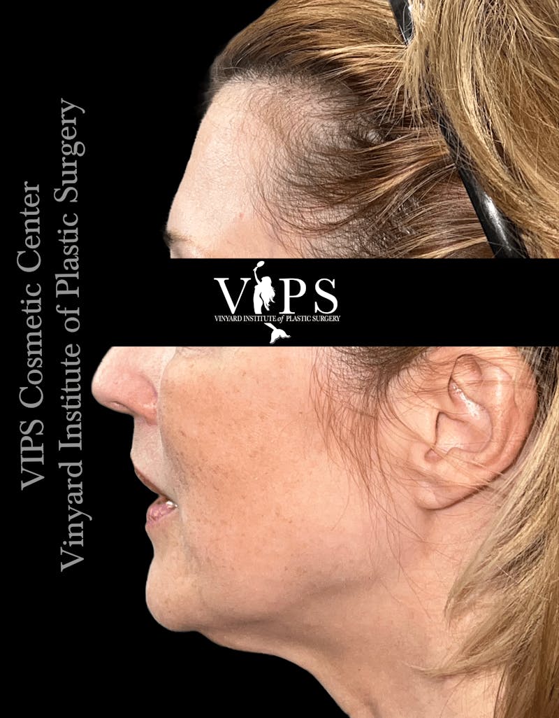 ELLUMINATE WITH IPL Before & After Gallery - Patient 361340 - Image 3