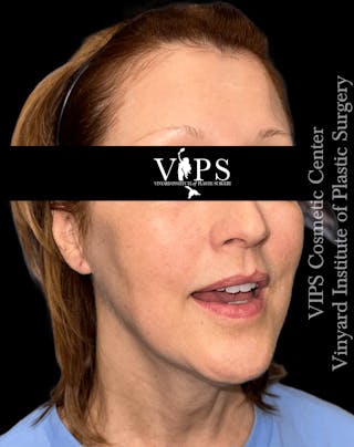 ELLUMINATE WITH IPL Before & After Gallery - Patient 361340 - Image 2