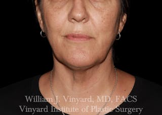 Morpheus8 BODY RF Microneedling Before & After Gallery - Patient 271048 - Image 2