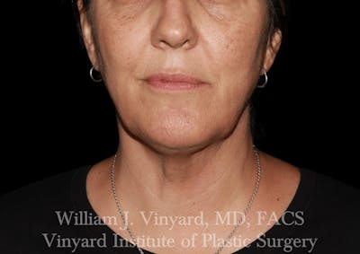 Morpheus8 BODY RF Microneedling Before & After Gallery - Patient 271048 - Image 2