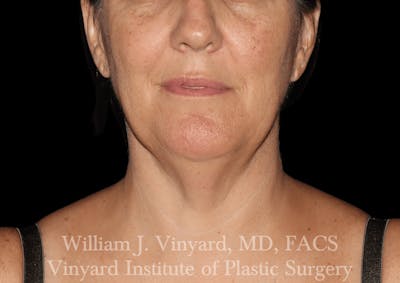 Morpheus8 BODY RF Microneedling Before & After Gallery - Patient 271048 - Image 1