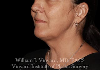 Morpheus8 BODY RF Microneedling Before & After Gallery - Patient 271048 - Image 4
