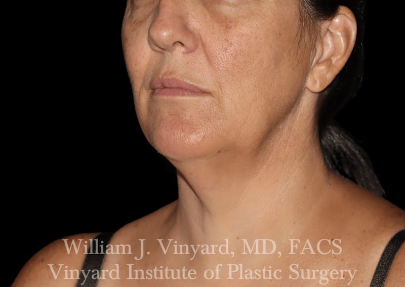 Facetite Before & After Gallery - Patient 403917 - Image 7