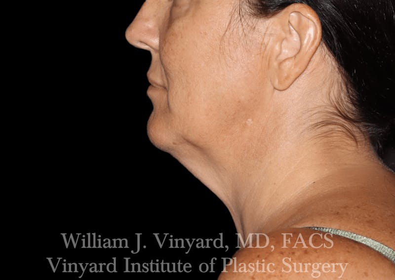 Facetite Before & After Gallery - Patient 403917 - Image 9