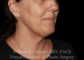 Morpheus8 BODY RF Microneedling Before & After Gallery - Patient 271048 - Image 8