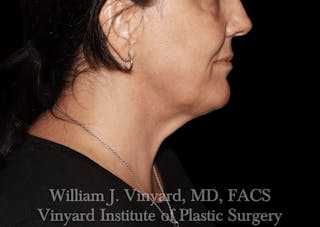 Morpheus8 BODY RF Microneedling Before & After Gallery - Patient 271048 - Image 10