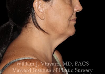 Facetite Before & After Gallery - Patient 403917 - Image 1