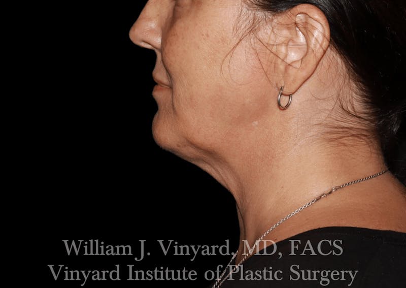 Facetite Before & After Gallery - Patient 403917 - Image 10