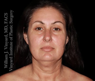 RF Microneedling Morpheus 8 Before & After Gallery - Patient 160671 - Image 1