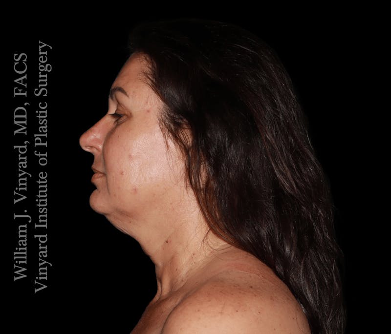 RF Microneedling Morpheus 8 Before & After Gallery - Patient 160671 - Image 5