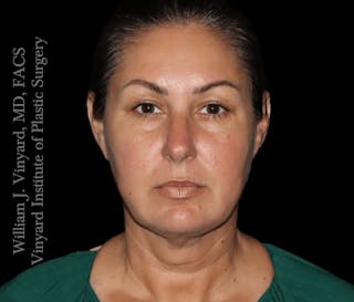 RF Microneedling Morpheus 8 Before & After Gallery - Patient 160671 - Image 2