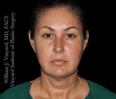 Morpheus8 RF Microneedling Before & After Gallery - Patient 160671 - Image 2