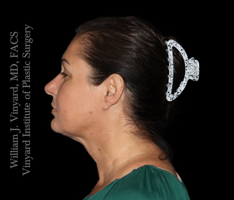 RF Microneedling Morpheus 8 Before & After Gallery - Patient 160671 - Image 6