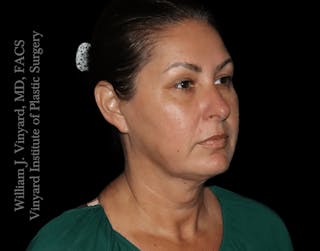 RF Microneedling Morpheus 8 Before & After Gallery - Patient 160671 - Image 8