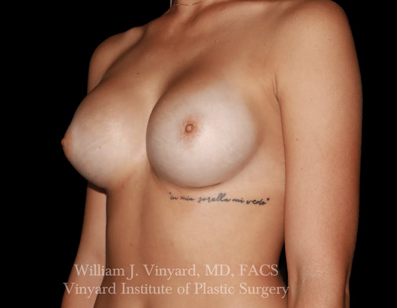 Breast Augmentation Before & After Gallery - Patient 416669 - Image 4