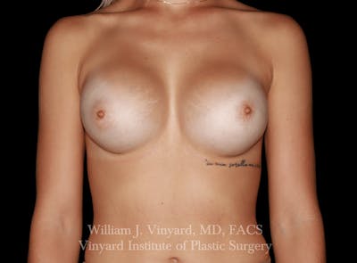 Breast Augmentation Before & After Gallery - Patient 416669 - Image 2