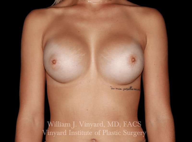 Breast Augmentation Before & After Gallery - Patient 416669 - Image 2